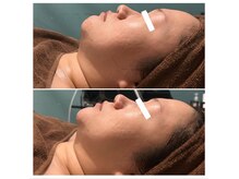 サロン ド メタセコイア(salon de Metasequoia)の雰囲気（３０代後半女性：施術１回　お悩み：毛穴、たるみ）