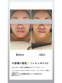オーダーメイド痩身&小顔矯正専門店Re:Lives【リライブ】金町店 【小顔ビフォアフ】ハイパーナイフとレモンボトルで結果出し◎