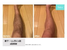 ティエル(TieLu)/足脱毛
