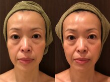 フリッシェ グラン(Frishe Gran)/一度の施術で驚きの効果