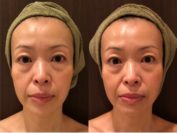 フリッシェ グラン(Frishe Gran)/一度の施術で驚きの効果