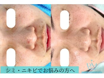 リメイクビューティークリニック(REMAKE BEAUTY CLINIC)/２回：ニキビ、シミケア