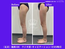 フェレザ 新潟(Felleza)/EMS-電気刺激