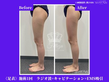 フェレザ 新潟(Felleza)/EMS-電気刺激