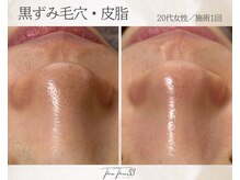 スリースリー(THREE THREE)/毛穴黒ずみ・詰まりケア