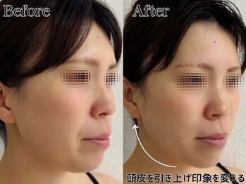 プルチャームエクイデム(Pulchram equidem)/新常識たるみケア「頭皮リフト」