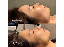 日本初！針を使わず肌に打ち込む美容施術♪最新機器で美肌づくり