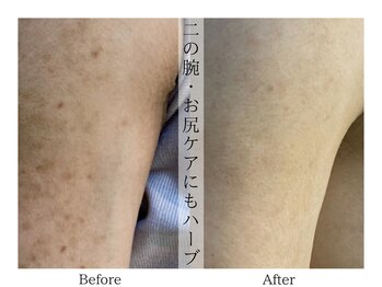 リララ(lelala)/ビフォーアフター☆