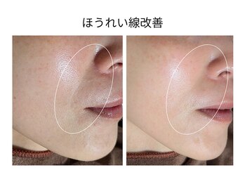 エボルブ 四条烏丸店(EVOLVE)/ほうれい線改善！