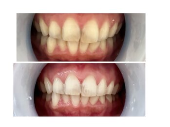 ココビューティー(COCOBEAUTY)/セルフホワイトニング