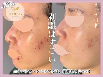 ハーバリー ハーブピーリング 大阪梅田店(HERBERRYハーブピーリング)/リベル・REVI・クリスティーナ