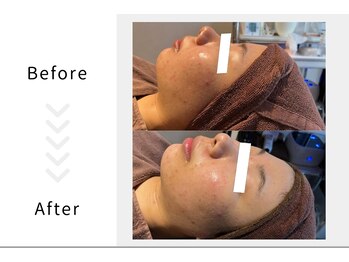 アブニールブリヨン/ハーブピーリング　Before After