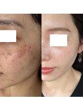 アンド ユー(and.yu)/シミケア・美肌コース1回