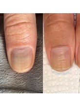 ウェルズユキ(well's yuki)/凹凸の爪　白い爪しか伸びない