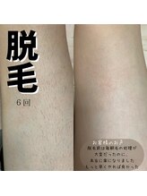 リベルテ(LIBERTE)/【学割】脱毛