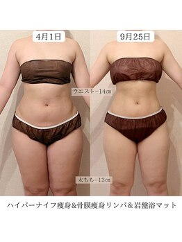 ピーチハート(Peach Heart)/ハイパー痩身ビフォーアフター