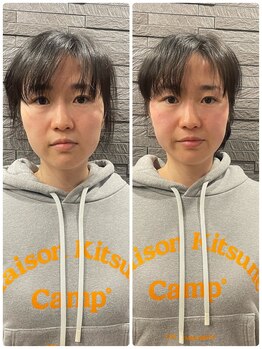 長寿鍼灸院 長寿整骨院/美容鍼50本の効果★小顔効果