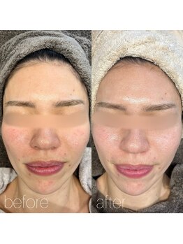 コア(koa)/ハーブピーリング【大阪/布施】