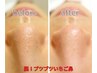 毛穴の汚れ、黒ずみを徹底改善！超ウルトラ毛穴洗浄¥3,900(特許取得の特殊水)