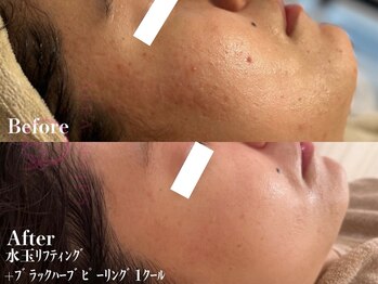 サロンヴェアリー 広尾(salon vary)/お肌のゴワつき、ニキビケアに！