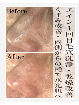 ジョルフ サロン オリジナル(JOLF salon original)/夏前に毛穴もお肌もスッキリ