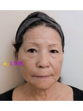 リアンシャンテ(Re enchanter)/☆お手入れ１年後(ノーメイク)