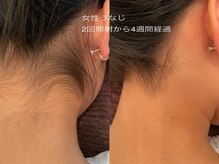 なちゅらる 苫小牧/うなじ脱毛