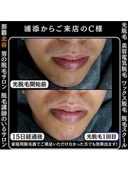 ディースタイル 北谷店(Dstyle)/北谷メンズ脱毛ヒゲBefore After