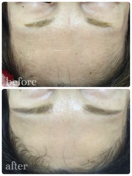 メイユール(MEILLEUR)/光フェイシャル6回