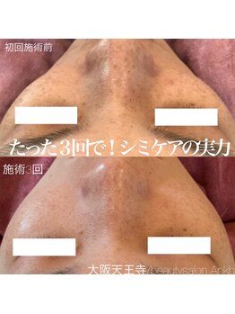 アンク(Ankh)/たったの3回でこの結果