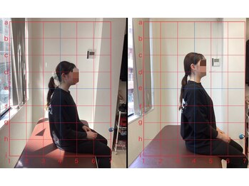 とるこり美姿整体院 新宿院/ 30代女性-猫背矯正Before/After