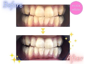 エクシアホワイトニング 武蔵小杉店/ビフォーアフター