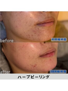 ルアナ 北谷店/ハーブピーリング 《沖縄/北谷》