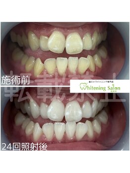 ホワイトニングサロン 札幌店/【ホワイトニング】#札幌#大通り