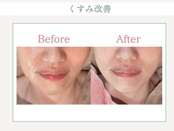 トータルビューティー ゆみえエステ(Total Beauty)/光フォト(光フェイシャル)