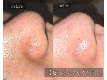 ル シーニュ/くすみ毛穴20代