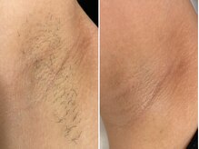 フェミソワン(FemiSoin)