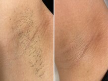 フェミソワン(FemiSoin)