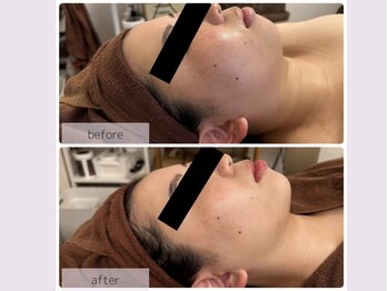 リバース 大阪店(Rebirth)/輪郭すっきり♪顔も脂肪燃焼