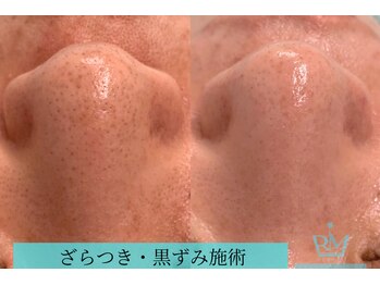 リメイクビューティークリニック(REMAKE BEAUTY CLINIC)/毛穴の黒ずみ、ざらつき改善