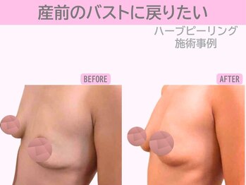 ぷるるんエステ/ハーブピーリング/バストケア