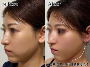 プルチャームエクイデム(Pulchram equidem)/新常識たるみケア「頭皮リフト」