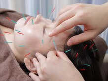 南行徳ひびき整骨院/美容鍼