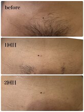 シャルム(Charme)/Vライン脱毛2回