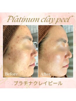 脱毛専門店 美的/美肌改善！プラチナクレイピール