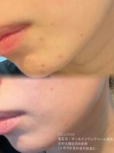 話題の肌質改善メニュー＆自社開発CELLNAGEでワンランク上の美肌へ