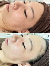 アトレ アンド ミューズ(Attrait×Muse)/【たるみ改善/シワ改善】