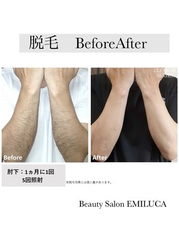 エミルカ(EMILUCA)/両腕脱毛