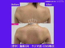 フェレザ 新潟(Felleza)/寝てるだけで筋肉を作るEMS