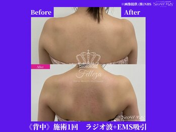 フェレザ 新潟(Felleza)/寝てるだけで筋肉を作るEMS